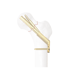 Locking Composite Compression Commecting Plate