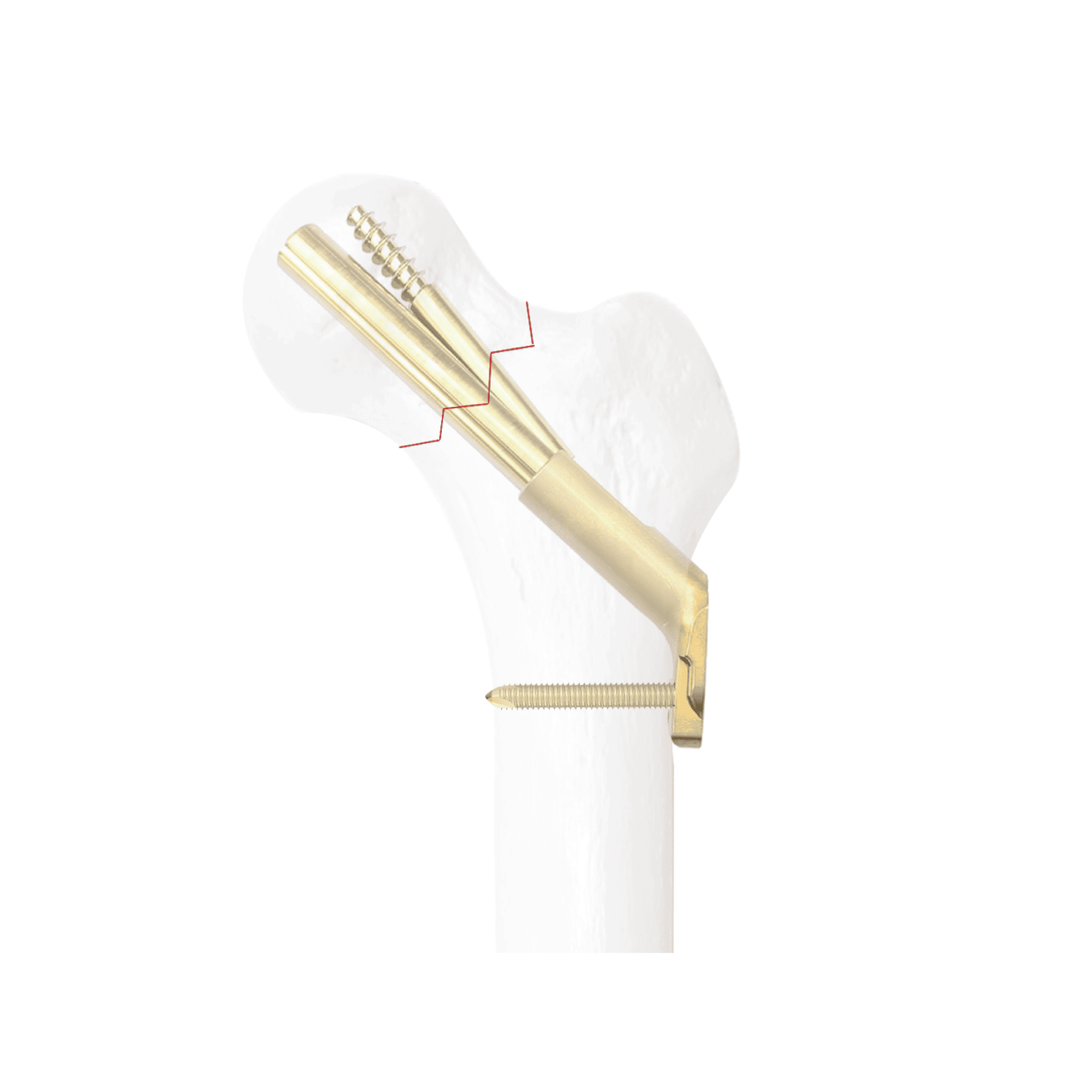 Locking Composite Compression Commecting Plate